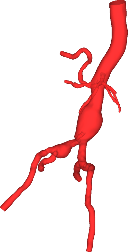 Modelo tridimensional de la aorta abdominal segmentada a partir de imagen medica